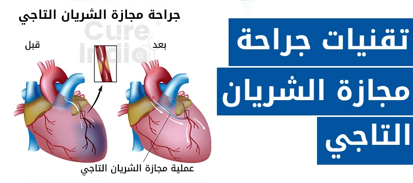 تقنيات جراحة مجازة الشريان التاجي في الهند